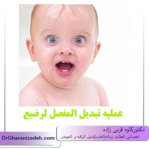 عملیه تبدیل المفصل الرضیع