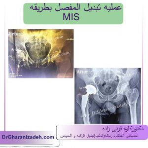 تبدیل مفصل الفخذ مع أقل نسبه تهاجم(جراحه و نزیف)