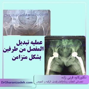 عملیه تبدیل المفصل