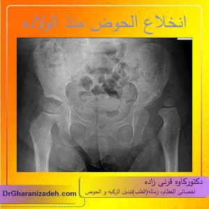 انخلاع الحوض