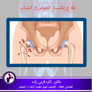 جراحة لاستبدال مفصل الورك لدى الشباب