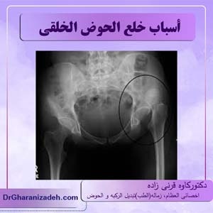 أسباب خلع الحوض الخلقي