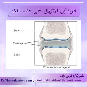 ادرينالين-الانزلاق-على-عظم-الفخذ-(مرض-النعال)