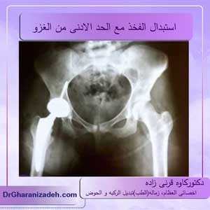 استبدال الفخذ مع الحد الادنى من الغزو     