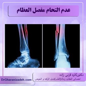 عدم التحام مفصل العظام